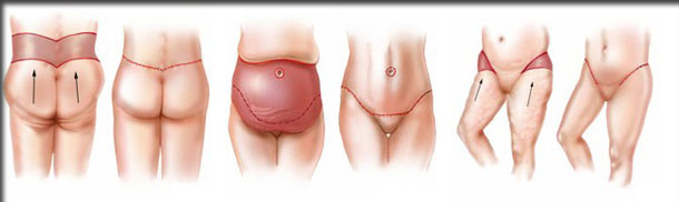 Lower body lift discount