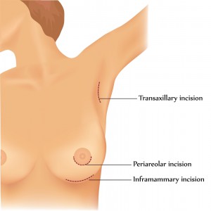 Diagram of a woman's breast