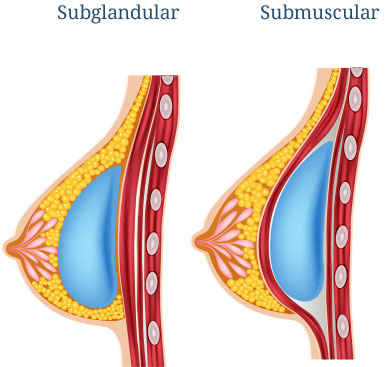 Diagram of breast implants