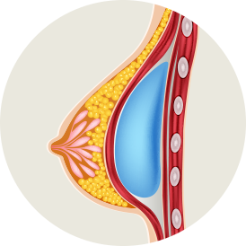 Diagram of a submuscular breast implant