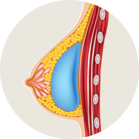 diagram of a subglandular breast implant