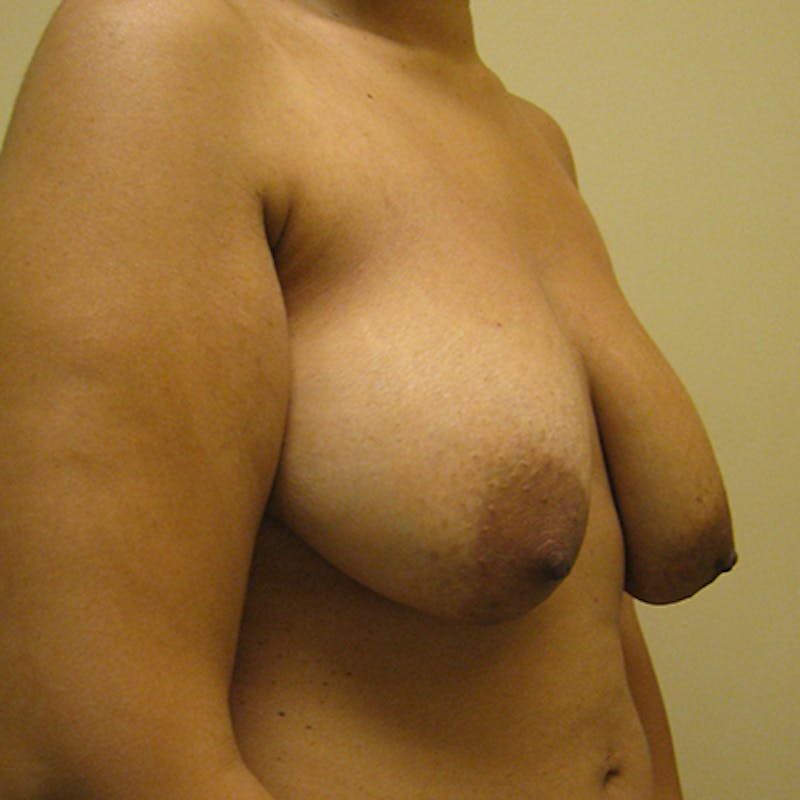 Composite Breast Surgery Before & After Gallery - Patient 154361629 - Image 3
