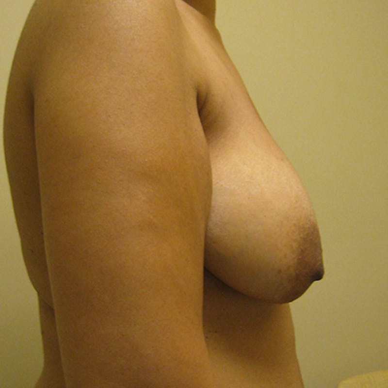 Composite Breast Surgery Before & After Gallery - Patient 154361629 - Image 5