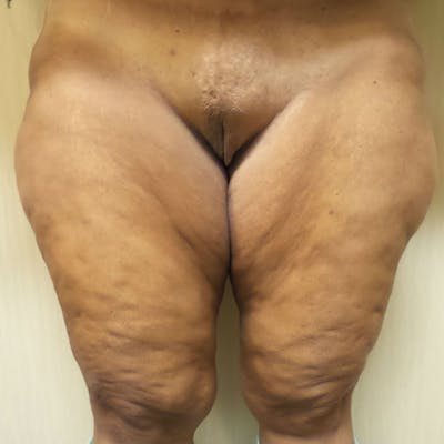 Thigh Lift Before & After Gallery - Patient 154532247 - Image 1
