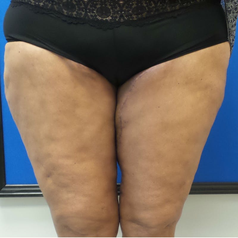 Thigh Lift Before & After Gallery - Patient 154532247 - Image 2