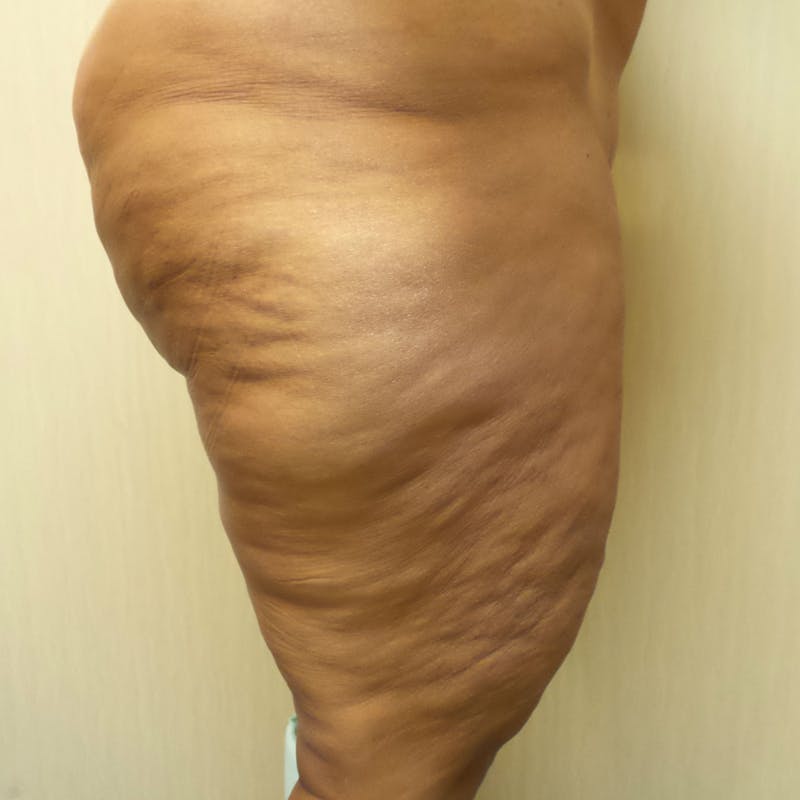 Thigh Lift Before & After Gallery - Patient 154532247 - Image 3