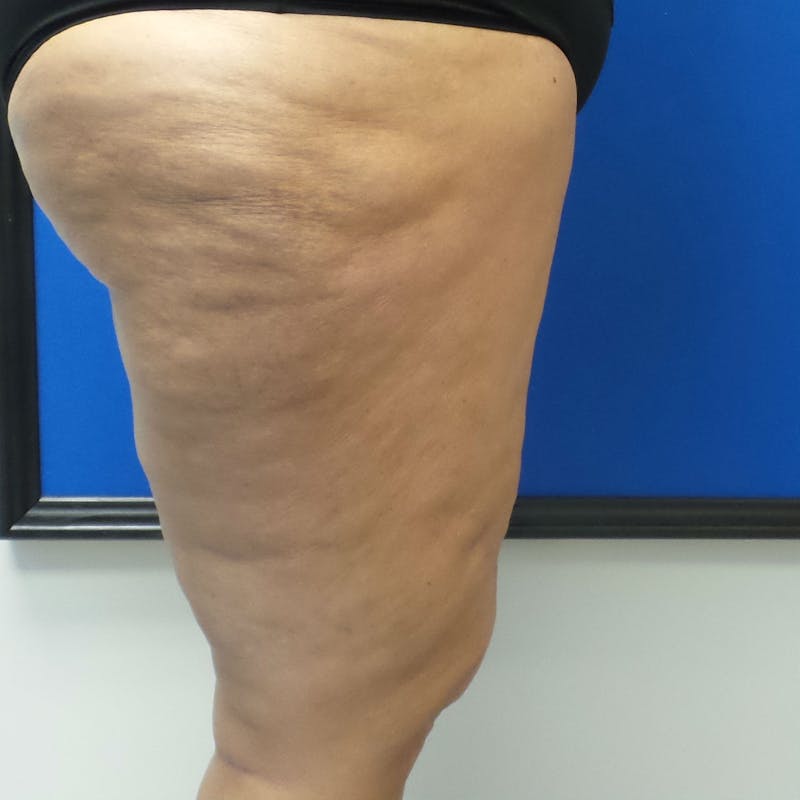 Thigh Lift Before & After Gallery - Patient 154532247 - Image 4