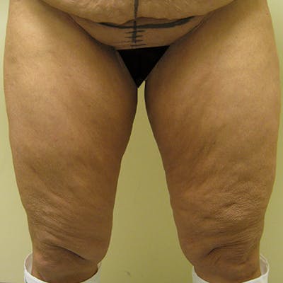 Thigh Lift Before & After Gallery - Patient 154532251 - Image 1