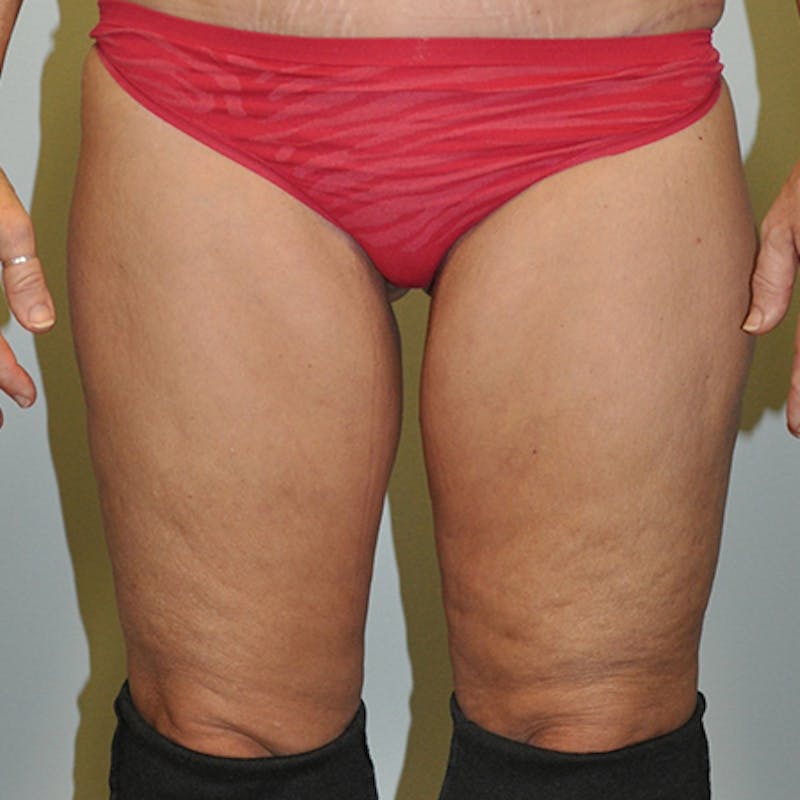 Thigh Lift Before & After Gallery - Patient 154532251 - Image 2