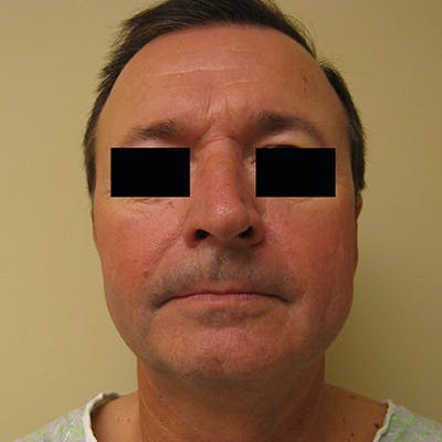 Face & Neck Lift Before & After Gallery - Patient 154532347 - Image 1