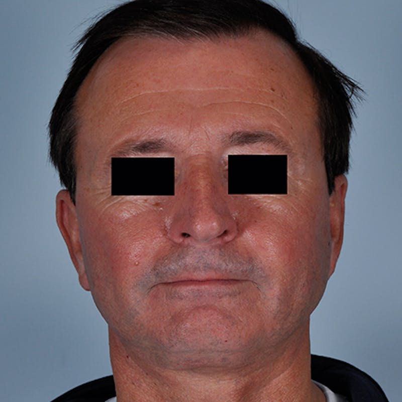 Face & Neck Lift Before & After Gallery - Patient 154532347 - Image 2