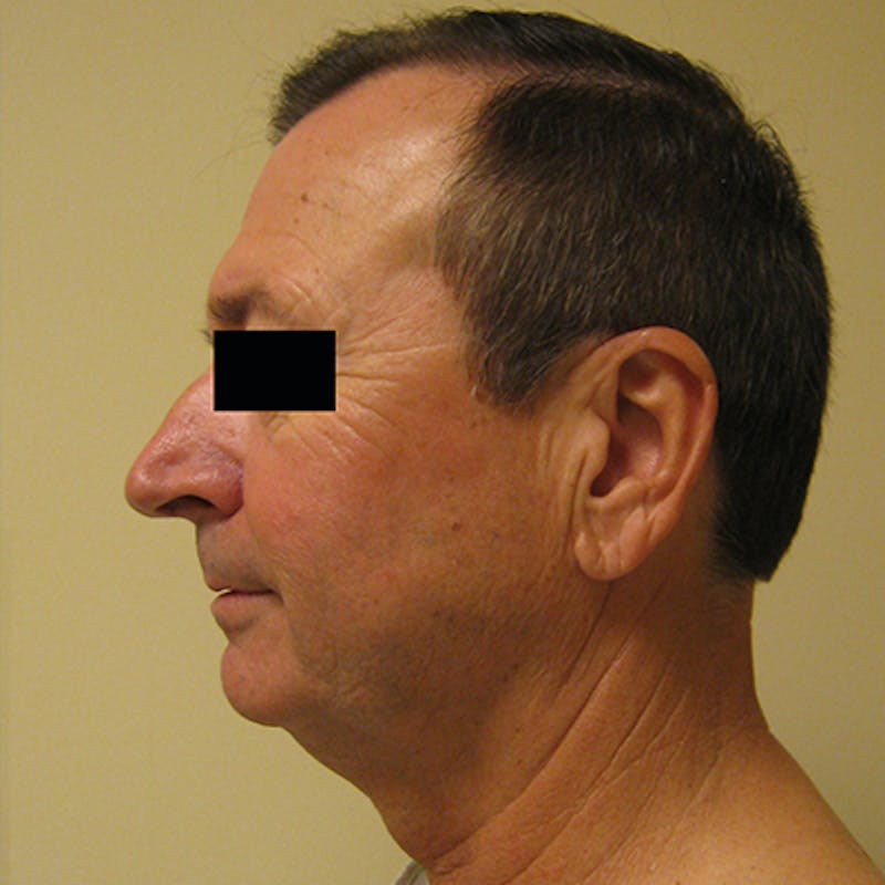 Face & Neck Lift Before & After Gallery - Patient 154532347 - Image 3