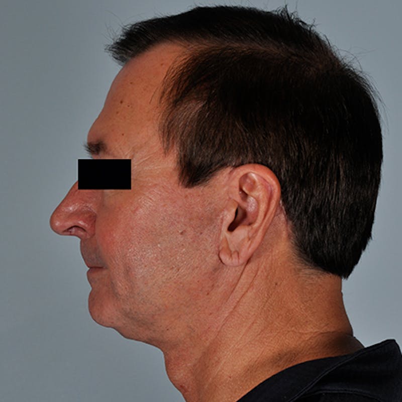 Face & Neck Lift Before & After Gallery - Patient 154532347 - Image 4