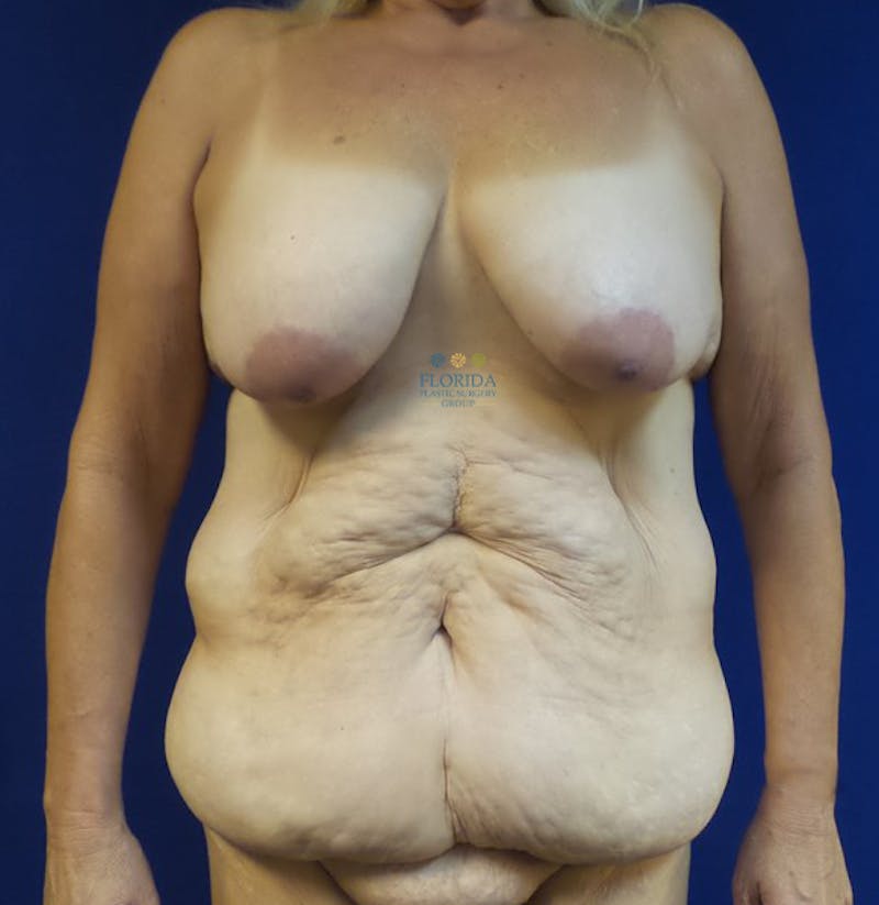 Composite Breast Surgery Before & After Gallery - Patient 154948643 - Image 1