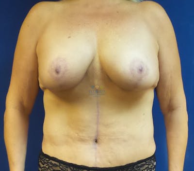 Composite Breast Surgery Before & After Gallery - Patient 154948643 - Image 2
