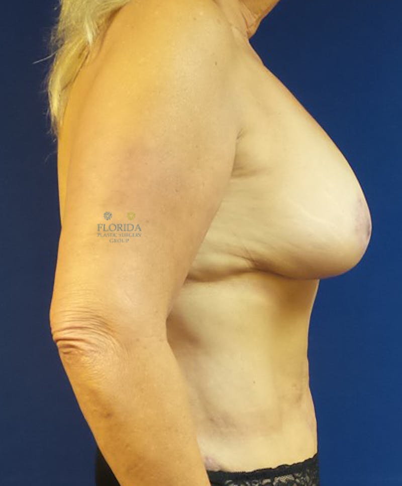 Composite Breast Surgery Before & After Gallery - Patient 154948643 - Image 4