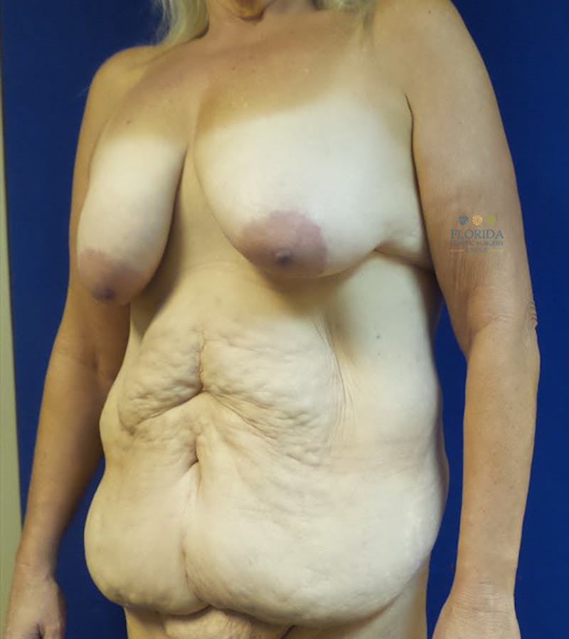 Composite Breast Surgery Before & After Gallery - Patient 154948643 - Image 5