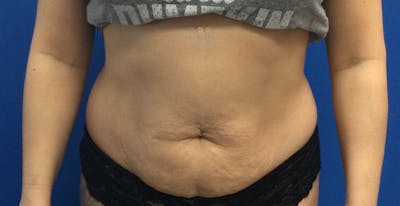Liposuction Before & After Gallery - Patient 154948649 - Image 1