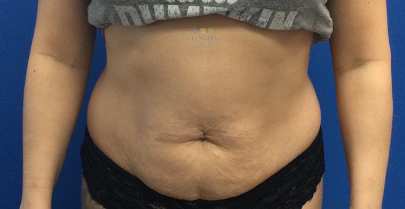 Liposuction Before & After Gallery - Patient 154948649 - Image 1