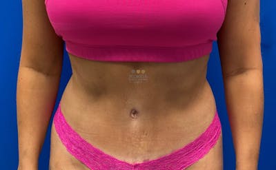 Liposuction Before & After Gallery - Patient 154948649 - Image 2