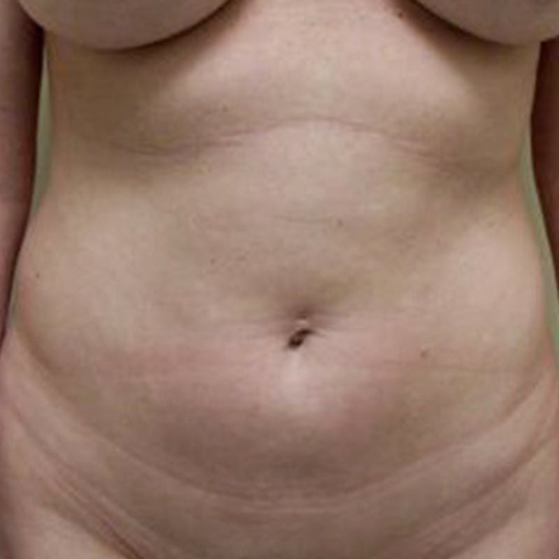 Liposuction Before & After Gallery - Patient 154948650 - Image 1