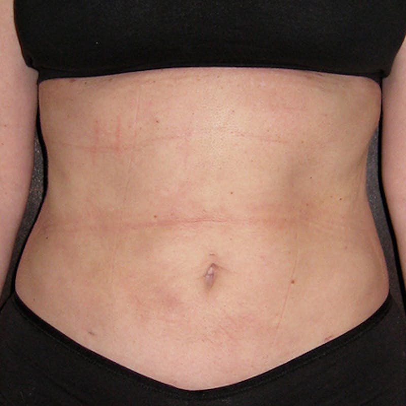 Liposuction Before & After Gallery - Patient 154948650 - Image 2