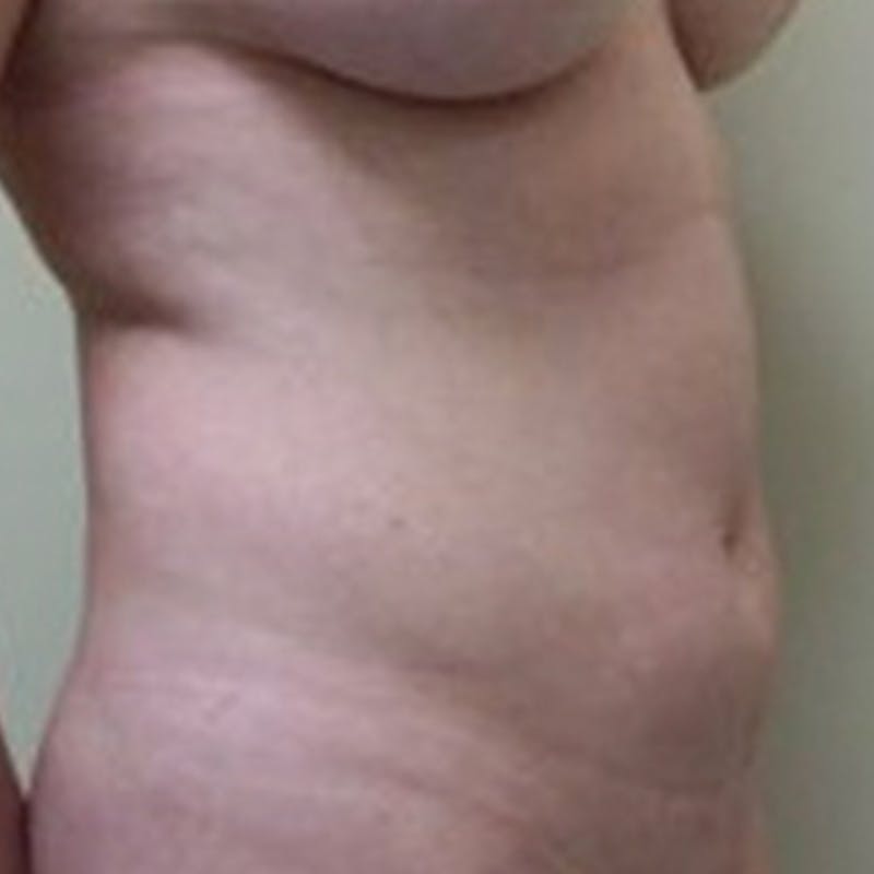 Liposuction Before & After Gallery - Patient 154948650 - Image 3