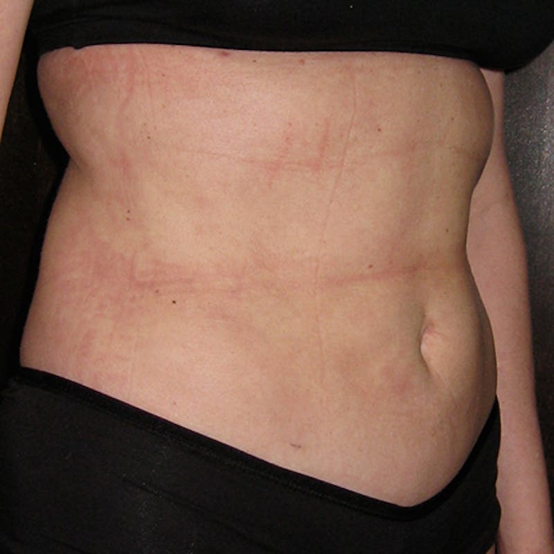 Liposuction Before & After Gallery - Patient 154948650 - Image 4