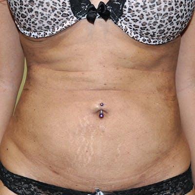 Liposuction Before & After Gallery - Patient 154948651 - Image 2