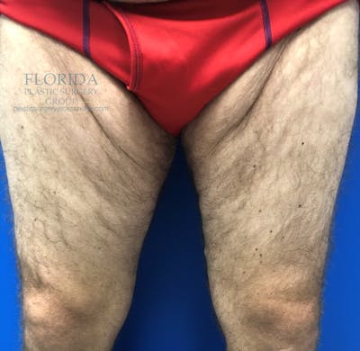 Thigh Lift Before & After Gallery - Patient 154948652 - Image 1