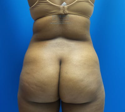 Liposuction Before & After Gallery - Patient 154948653 - Image 1