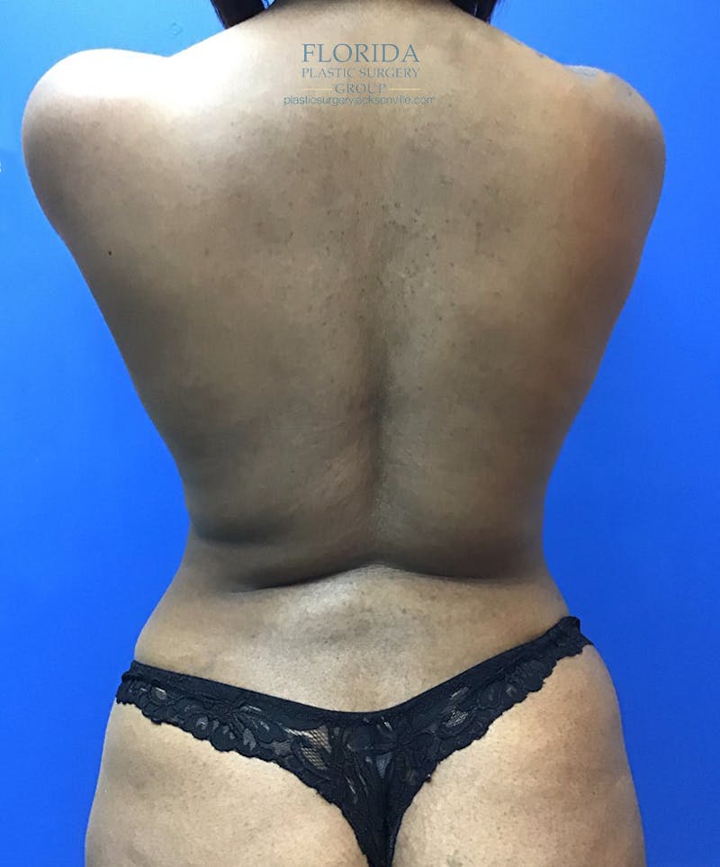 Liposuction Before & After Gallery - Patient 154948653 - Image 2