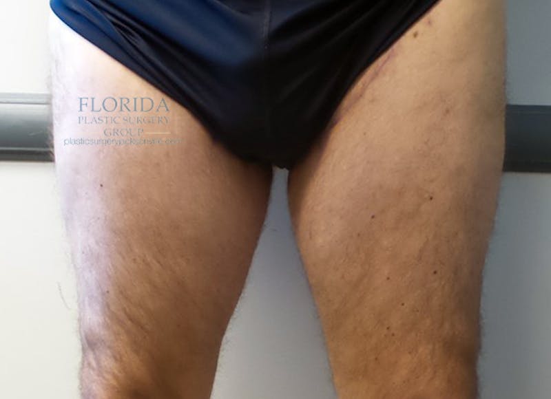 Thigh Lift Before & After Gallery - Patient 154948652 - Image 2