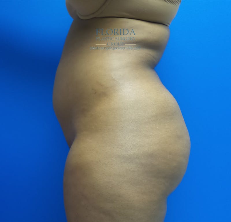 Liposuction Before & After Gallery - Patient 154948653 - Image 3