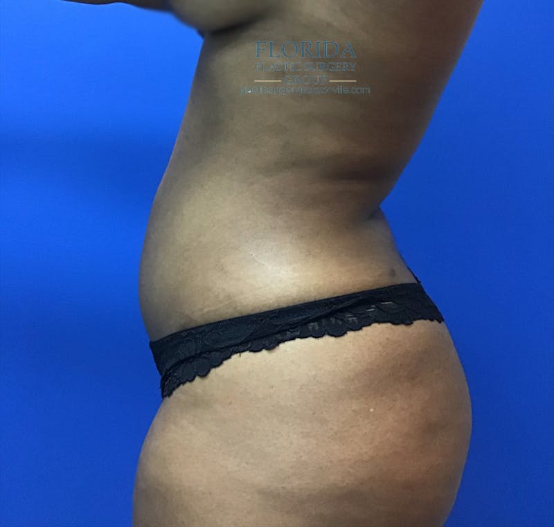 Liposuction Before & After Gallery - Patient 154948653 - Image 4