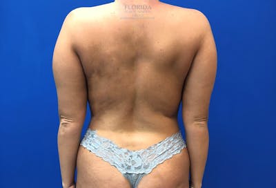Liposuction Before & After Gallery - Patient 154948654 - Image 1