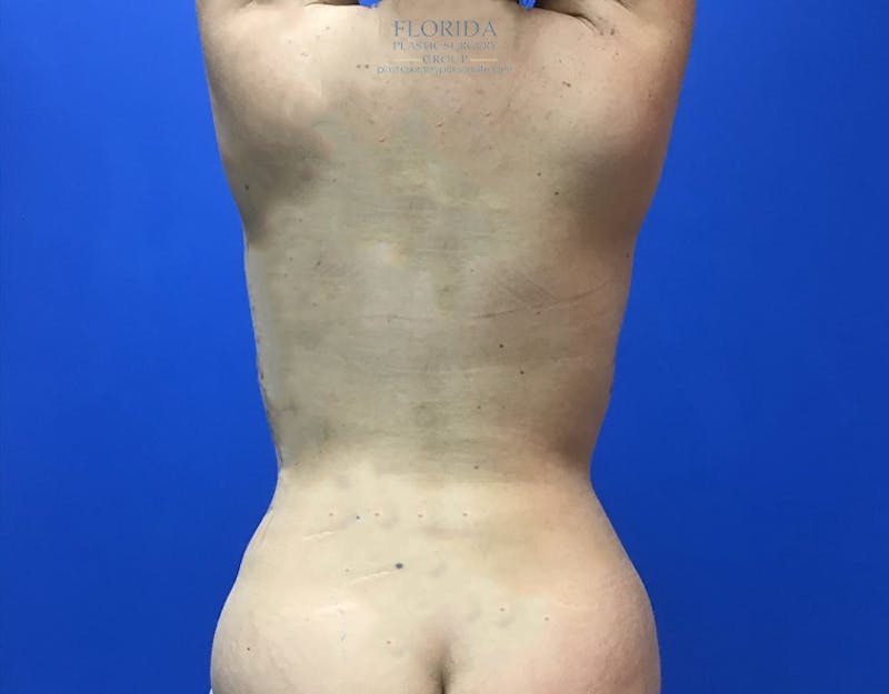 Liposuction Before & After Gallery - Patient 154948654 - Image 2