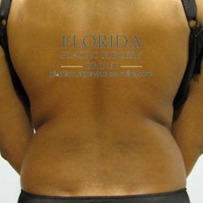 Liposuction Before & After Gallery - Patient 154948655 - Image 1