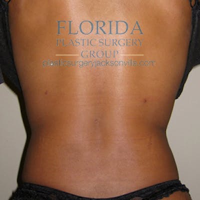 Liposuction Before & After Gallery - Patient 154948655 - Image 2