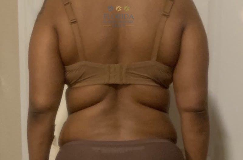 Liposuction Before & After Gallery - Patient 154948656 - Image 1