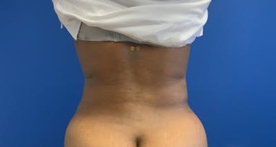 Liposuction Before & After Gallery - Patient 154948656 - Image 2