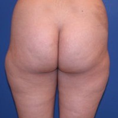 Liposuction Before & After Gallery - Patient 154948657 - Image 1