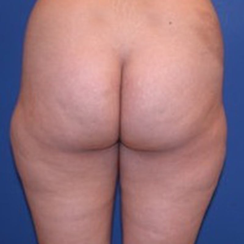 Liposuction Before & After Gallery - Patient 154948657 - Image 1