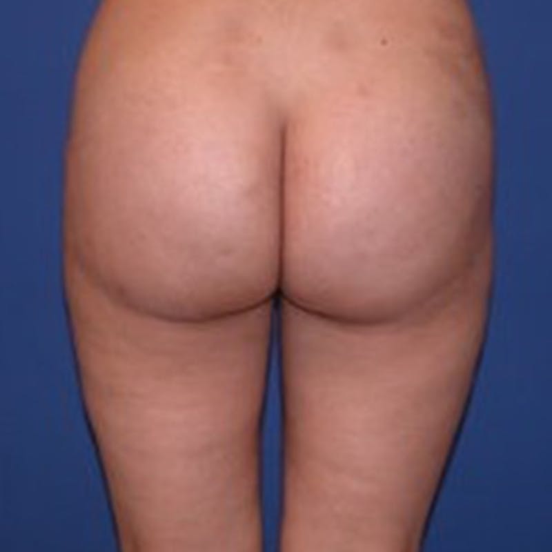 Liposuction Before & After Gallery - Patient 154948657 - Image 2