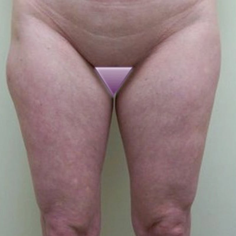 Liposuction Before & After Gallery - Patient 154948658 - Image 1