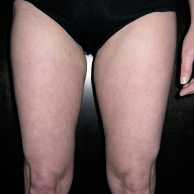 Liposuction Before & After Gallery - Patient 154948658 - Image 2