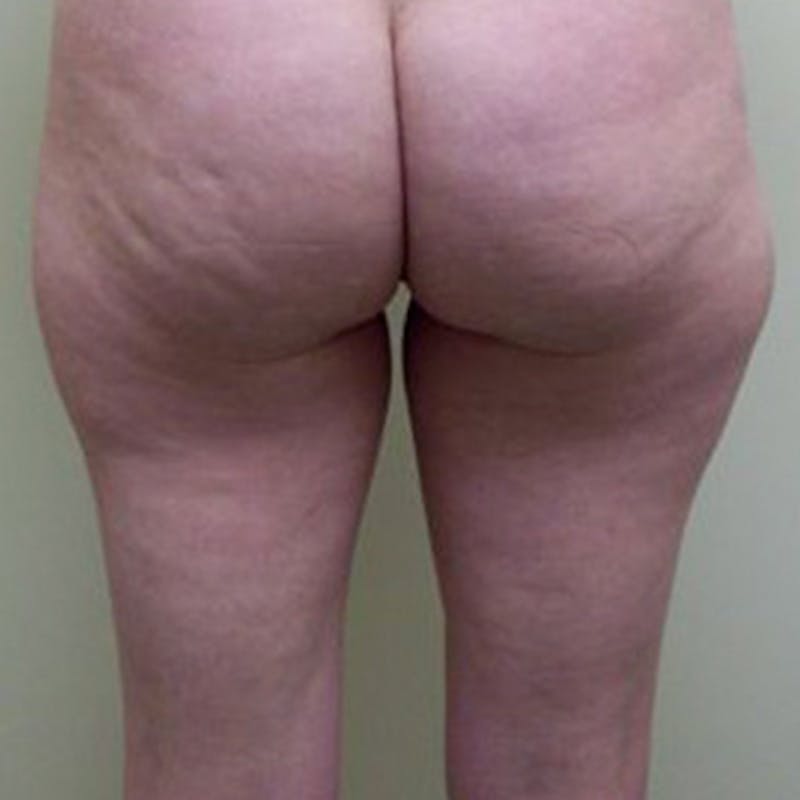Liposuction Before & After Gallery - Patient 154948658 - Image 3