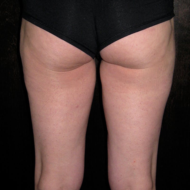 Liposuction Before & After Gallery - Patient 154948658 - Image 4