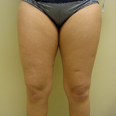 Liposuction Before & After Gallery - Patient 154948660 - Image 1