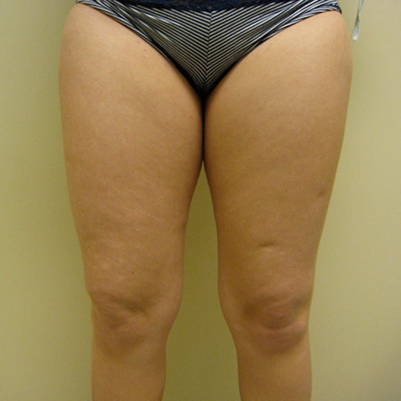 Liposuction Before & After Gallery - Patient 154948660 - Image 1